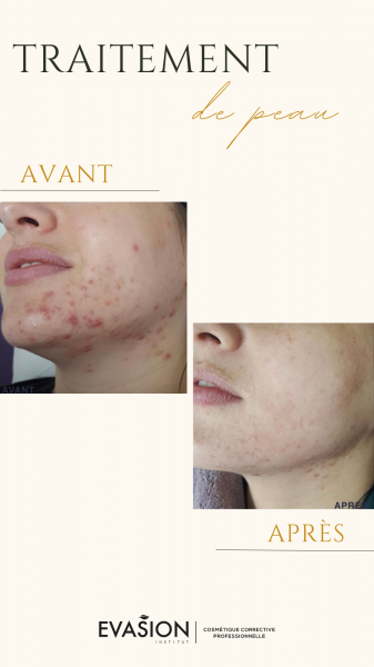 soin efficace contre l'acné en institut de beauté à Marseille 13008