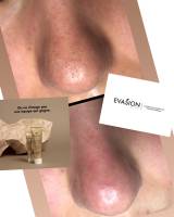 soin du visage efficace pour éliminer les points noirs sur le nez et le visage, institut de beauté Marseille 13008